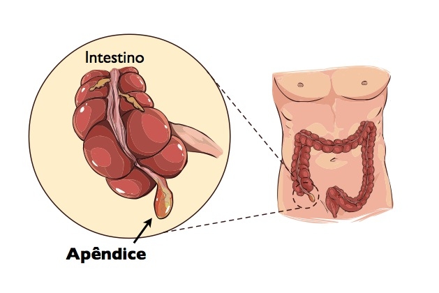 apendicite
